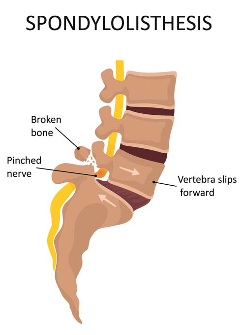Spondylolisthesis