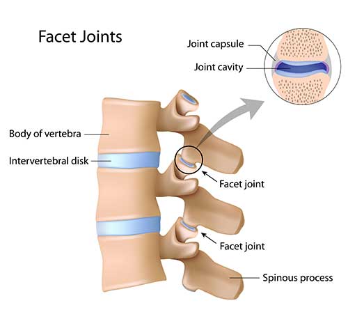 Facet-joint-injections