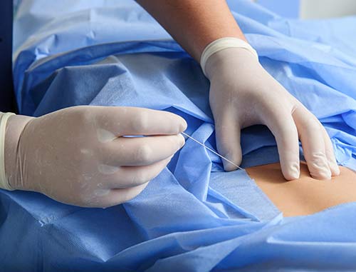 Spinal-injections
