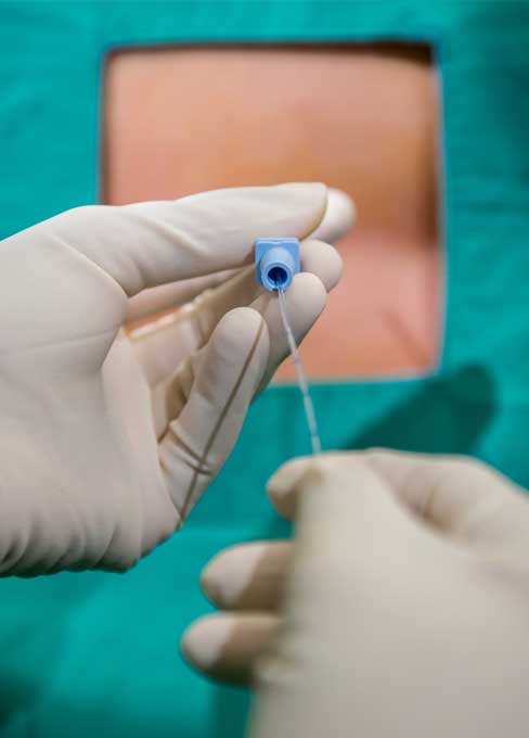 epidural-injections